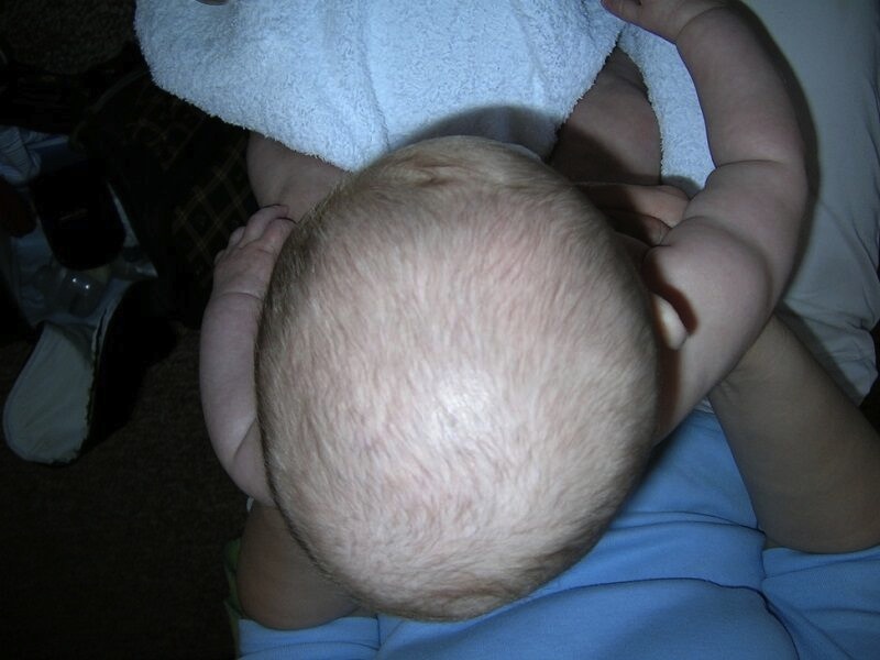 flat head baby plagiocephaly